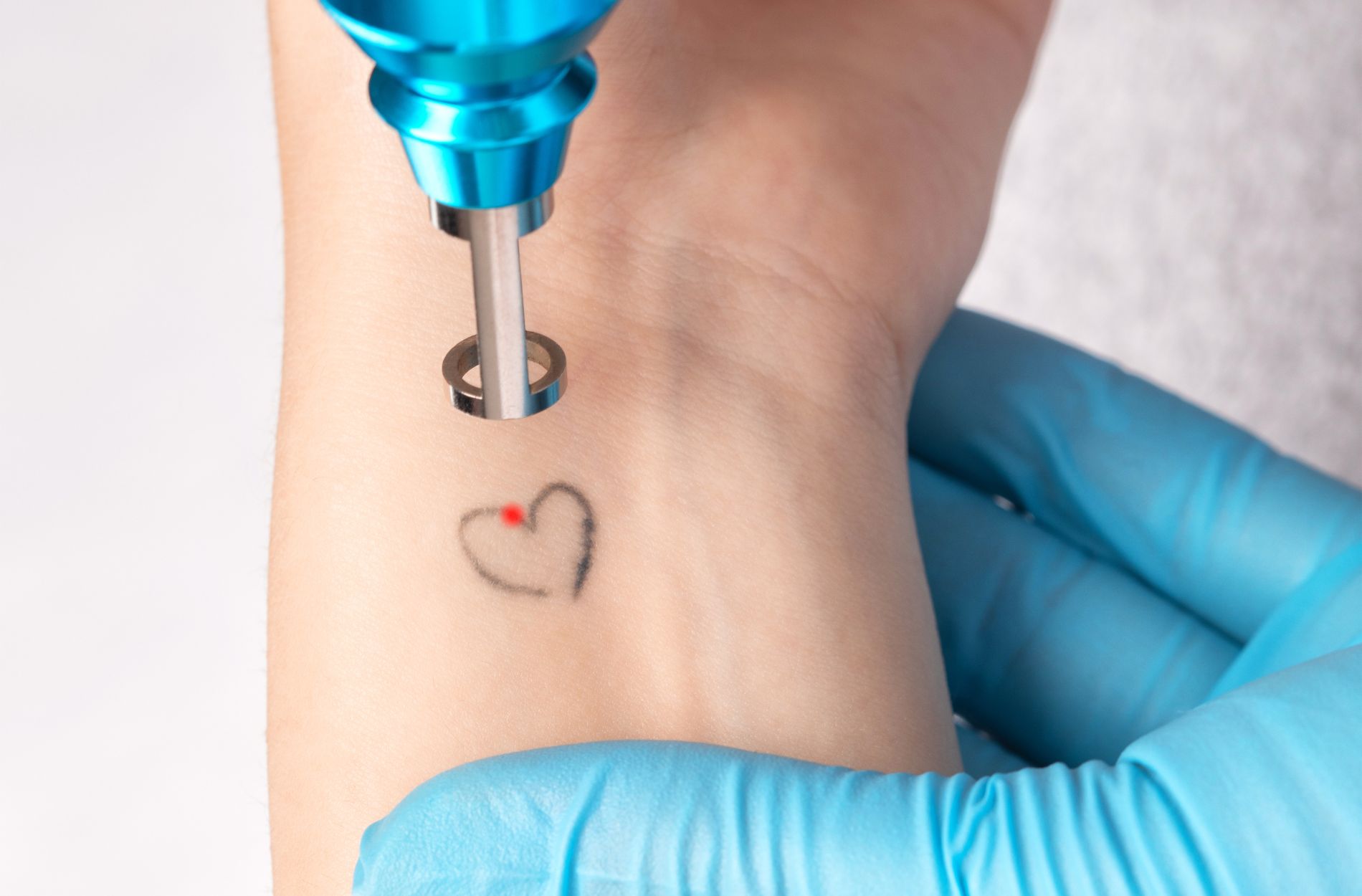 tattoo removal